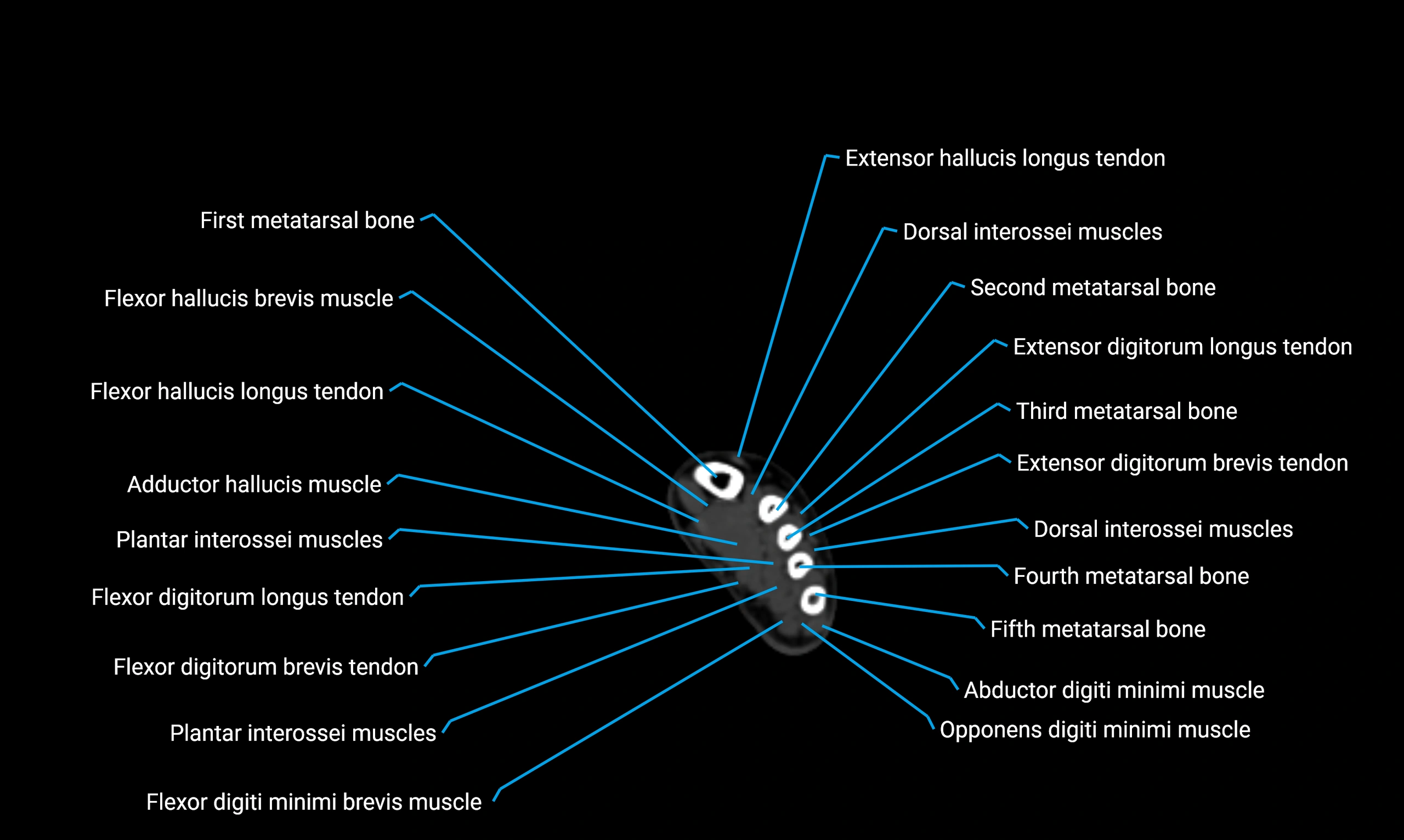 CT lower limb axial cross sectional anatomy labelled image 188 (2).webp